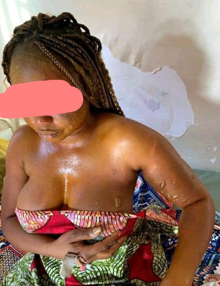 Jealous woman baths husband’s mistress with hot water in Benue 