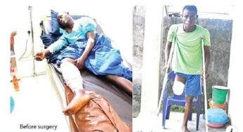 End SARS: I lost my right leg after I was shot at Lekki Toll Gate – 23-yr-old cobler