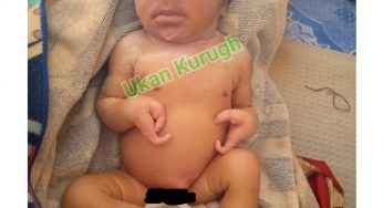 STRANGE: Baby born with two fingers, two toes in Benue (Photo)