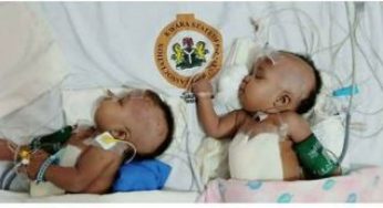 Conjoined twins separated at University of Ilorin Teaching Hospital (see photo)