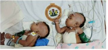 Conjoined twins separated at University of Ilorin Teaching Hospital (see photo)