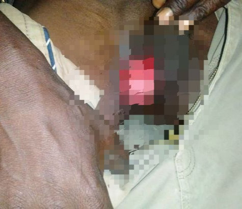 Wife bites off husband’s penis for allegedly cheating