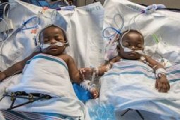 Conjoined twins born at Lagos State University die few days after delivery